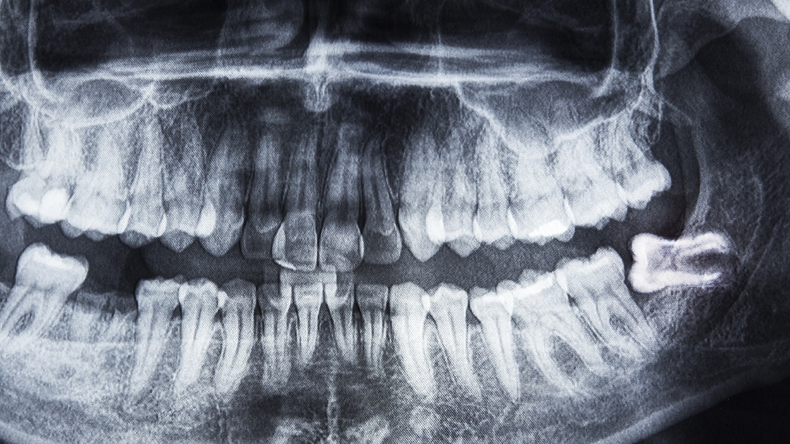 Wisdom Teeth Access Endodontics